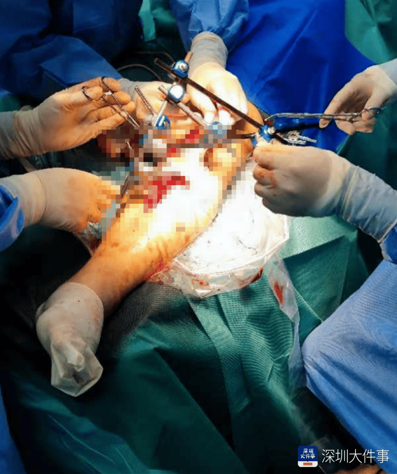 失血过半！深圳男子被三四百斤模具砸到<strong></p>
<p>炒原油交易平台</strong>，医生全力抢救