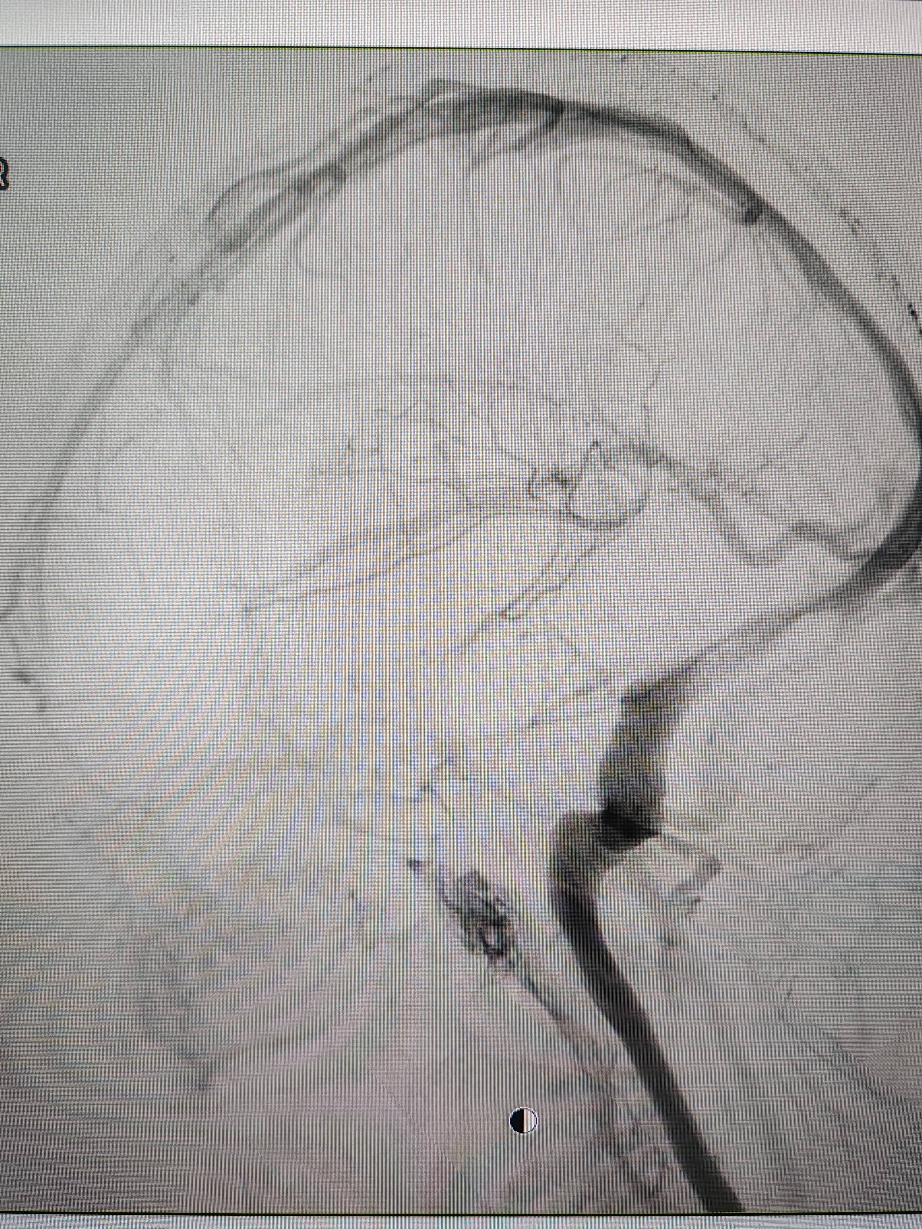 吉林女子患罕见耳鸣7年<strong></p>
<p>BFX合约平台</strong>，慕名千里来顺德寻医终获新生