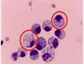 突然确诊<strong></p>
<p>exx交易平台下载</strong>！90后女子傻眼：不痛也不痒……很多人发现就是晚期