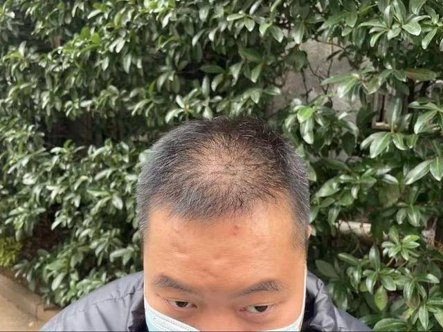 “还能反光<strong></p>
<p>bleutrade交易平台</strong>！”长沙男子植发近9月称后脑勺“像狗啃过”