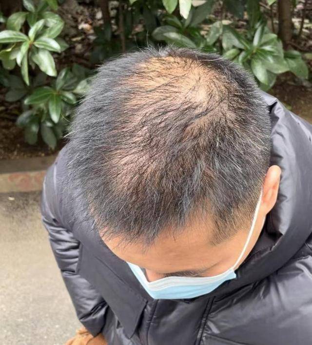 “还能反光<strong></p>
<p>bleutrade交易平台</strong>！”长沙男子植发近9月称后脑勺“像狗啃过”