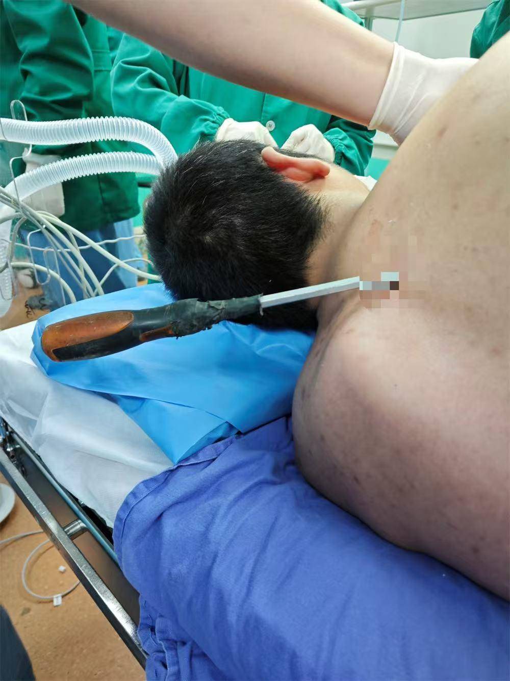 20米高空掉落螺丝刀直插男子胸腔<strong></p>
<p>炒平台币</strong>！医生：不要自行拔除