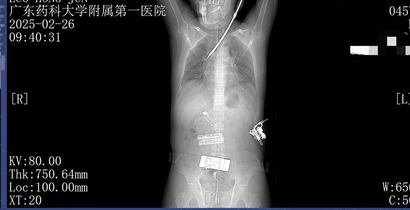 20米高空掉落螺丝刀直插男子胸腔<strong></p>
<p>炒平台币</strong>！医生：不要自行拔除