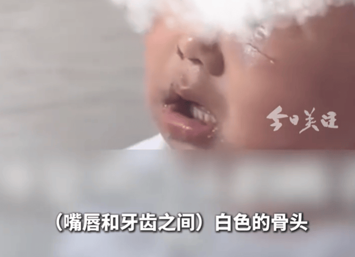 “多处撕裂，骨头已露出！”医生视频举报3岁男童疑遭虐待，警方已立案