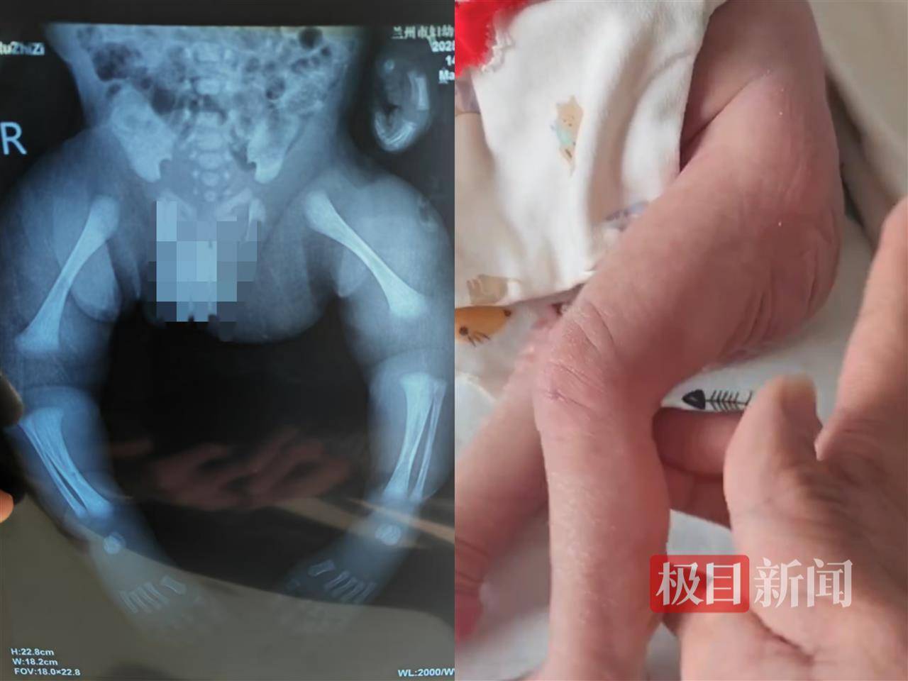 二胎出生查出先天性病症或落下残疾<strong></p>
<p>买币平台</strong>，残疾父母称医院产检漏检、未尽告知义务，医院及医调委回应