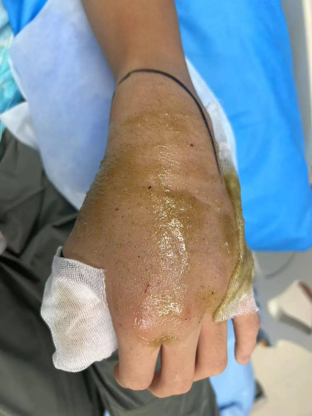 惊恐！毒蛇缠在自行车上<strong></p>
<p>bibox交易平台</strong>，深圳13岁男孩伸手被咬！近期超80人中招