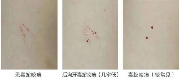 惊恐！毒蛇缠在自行车上<strong></p>
<p>bibox交易平台</strong>，深圳13岁男孩伸手被咬！近期超80人中招