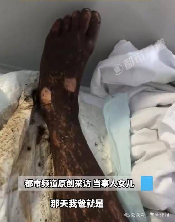 安徽宣城一男子走路玩手机<strong></p>
<p>应用币</strong>，一脚踩中打架的竹叶青和五步蛇，被俩毒蛇咬3口！医院：暂无生命危险，正在治疗