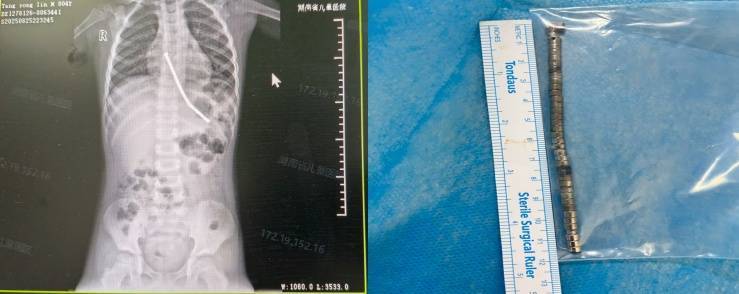 整整40颗<strong></p>
<p>星星币</strong>！湖南3岁男童身体里取出……医生紧急提醒