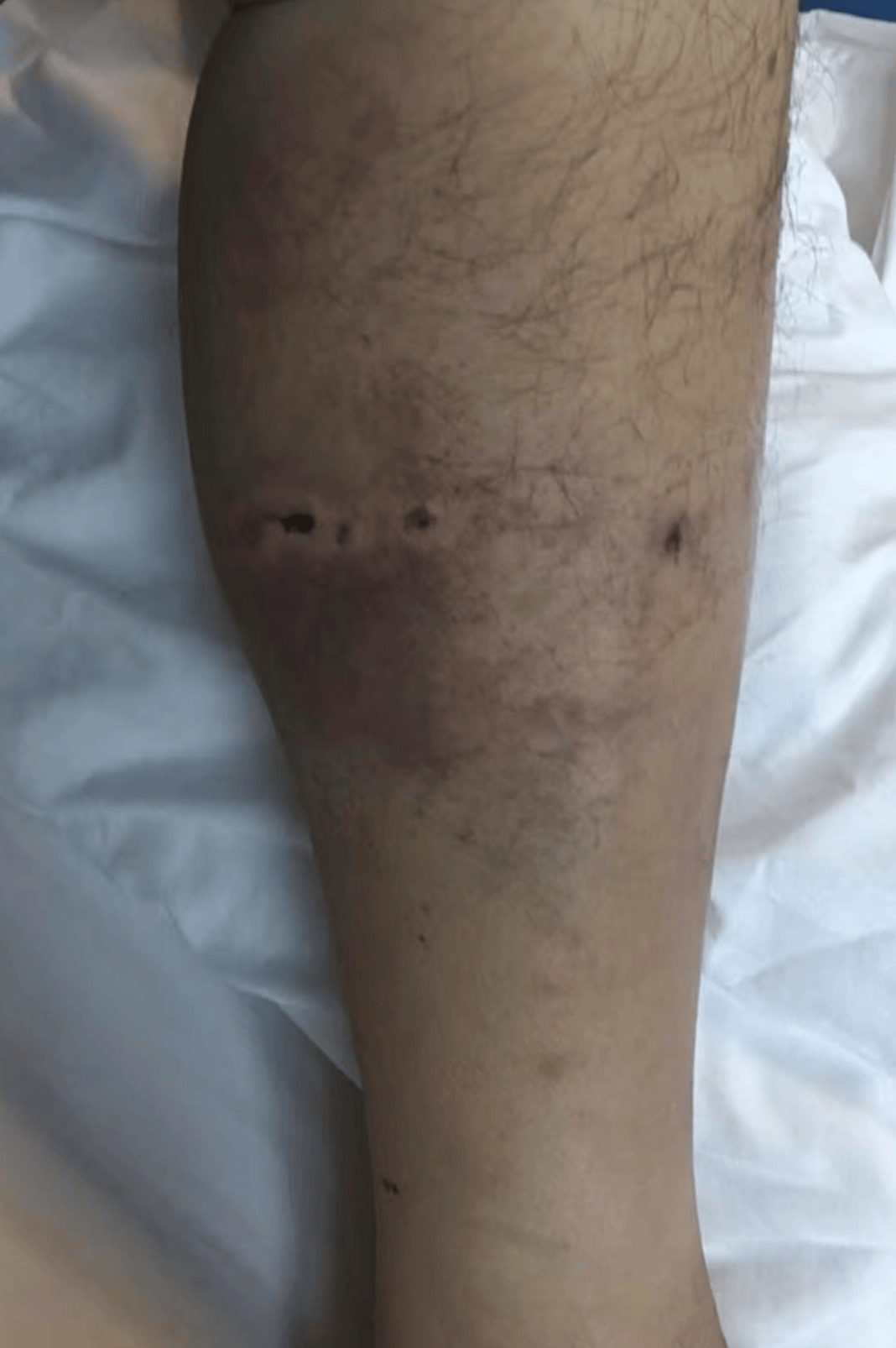 重庆男子上山采菌正面遇黑熊袭击<strong></p>
<p>鹿币</strong>，当事人：小腿被咬，穿的水鞋救了我一命；遭一掌打下山坡后险坠山崖幸被树枝拦住，醒后找到手机求救