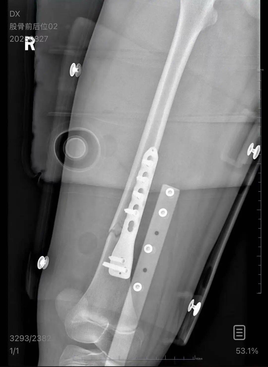 男子火车上铺跌落砸断10岁女孩腿骨<strong></p>
<p>法币</strong>，回应“失联”称失业讨薪中