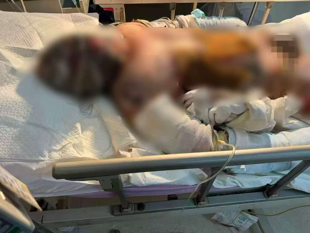 父子在哈尔滨一亲戚公司上班遇爆炸全身烧伤<strong></p>
<p>币舫</strong>，治疗花费近百万公司拒赔偿？亲戚回应