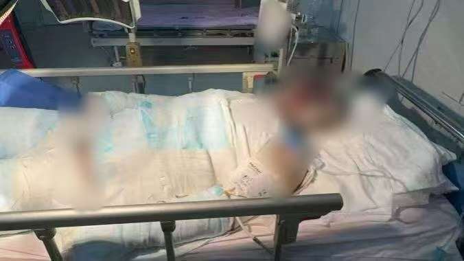 父子在哈尔滨一亲戚公司上班遇爆炸全身烧伤<strong></p>
<p>币舫</strong>，治疗花费近百万公司拒赔偿？亲戚回应