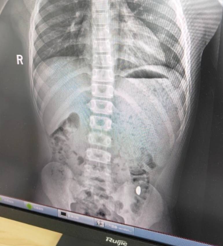 “熊孩子”误吞10克重金豆<strong></p>
<p>币率兑换</strong>，妈妈：天天叮嘱他不要在外面拉屎