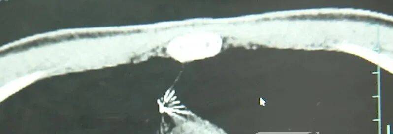 17岁小伙参军体检发现胸腔内有根5cm缝衣针<strong></p>
<p>奥德赛虚拟币</strong>，父母回忆或是1岁时扎入，取出时已锈迹斑斑