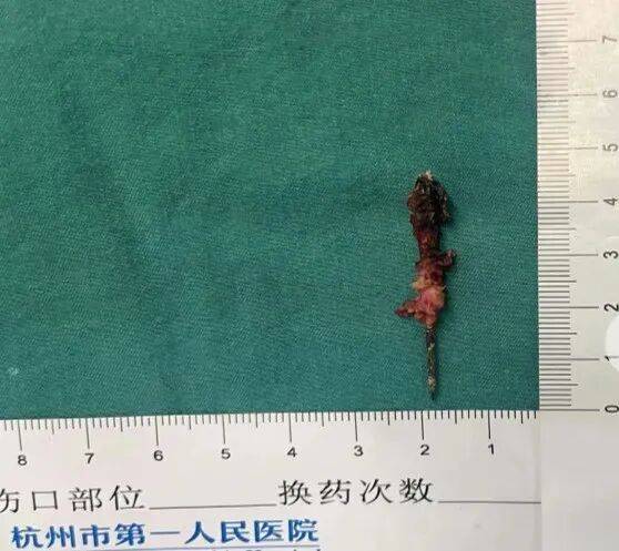 17岁小伙参军体检发现胸腔内有根5cm缝衣针<strong></p>
<p>奥德赛虚拟币</strong>，父母回忆或是1岁时扎入，取出时已锈迹斑斑